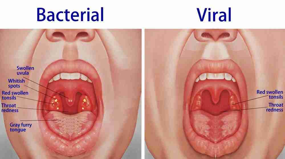 Viral vs Bacterial Throat Infection – How Define Difference